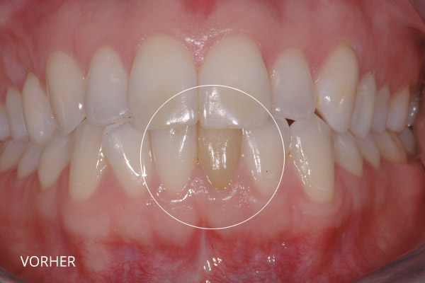 Ästhetische Zahnmedizin: internes Bleaching, vor der Behandlung