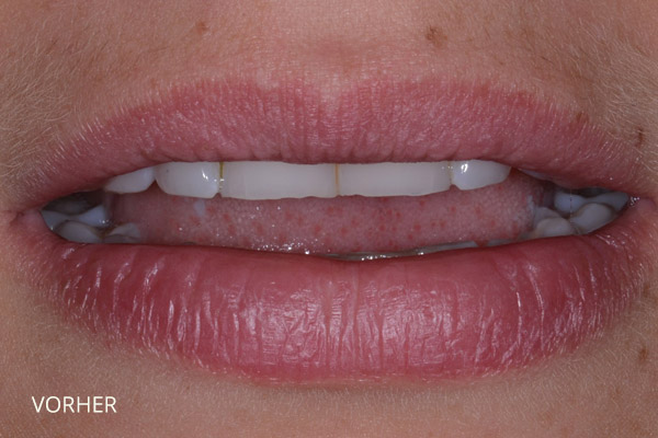 Zähneknirschen und Säureschäden: vor der Behandlung mit Kompositveneers