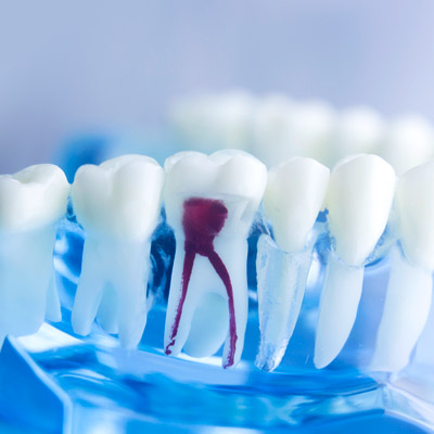 Eine Wurzelkanalbehandlung wird notwendig, wenn ein Zahnnerv entzündet oder infiziert ist.